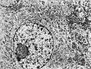 F,24y. | gangliocytoma